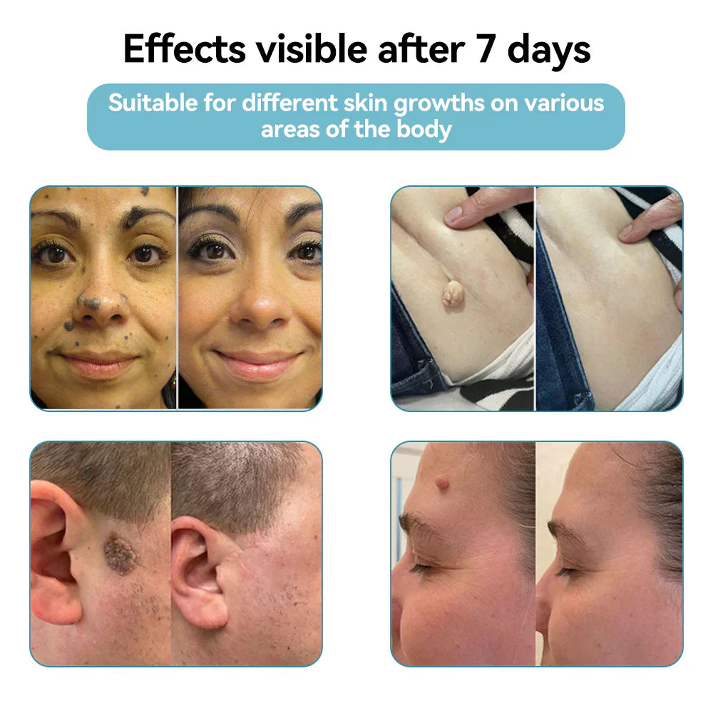 ☂WeHealthine® VelvetSkin+Series ⚔️All-in-One Laser Eraser Pen🖊️ (🔬Powered by CO₂ laser technology – effectively removes moles, warts, skin tags, pigmentation spots, and other skin imperfections)