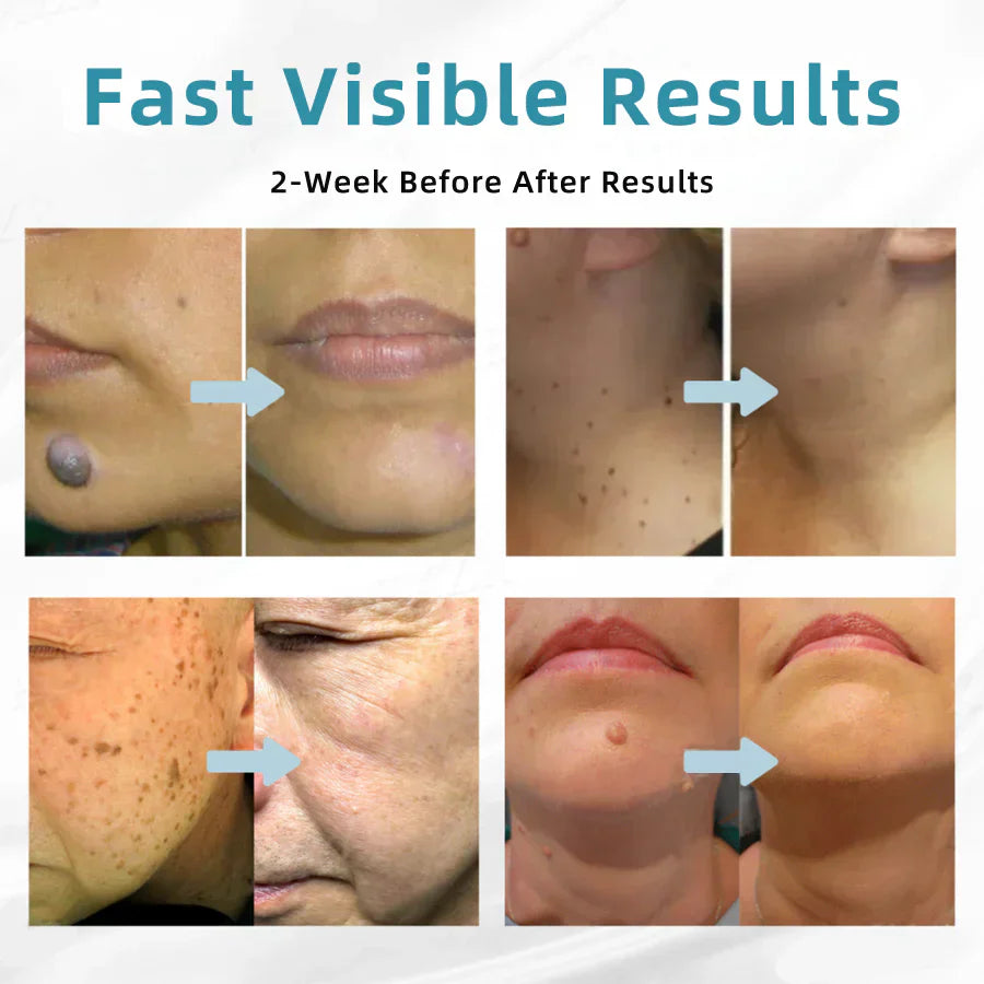 ☂WeHealthine® VelvetSkin+Series ⚔️All-in-One Laser Eraser Pen🖊️ (🔬Powered by CO₂ laser technology – effectively removes moles, warts, skin tags, pigmentation spots, and other skin imperfections)