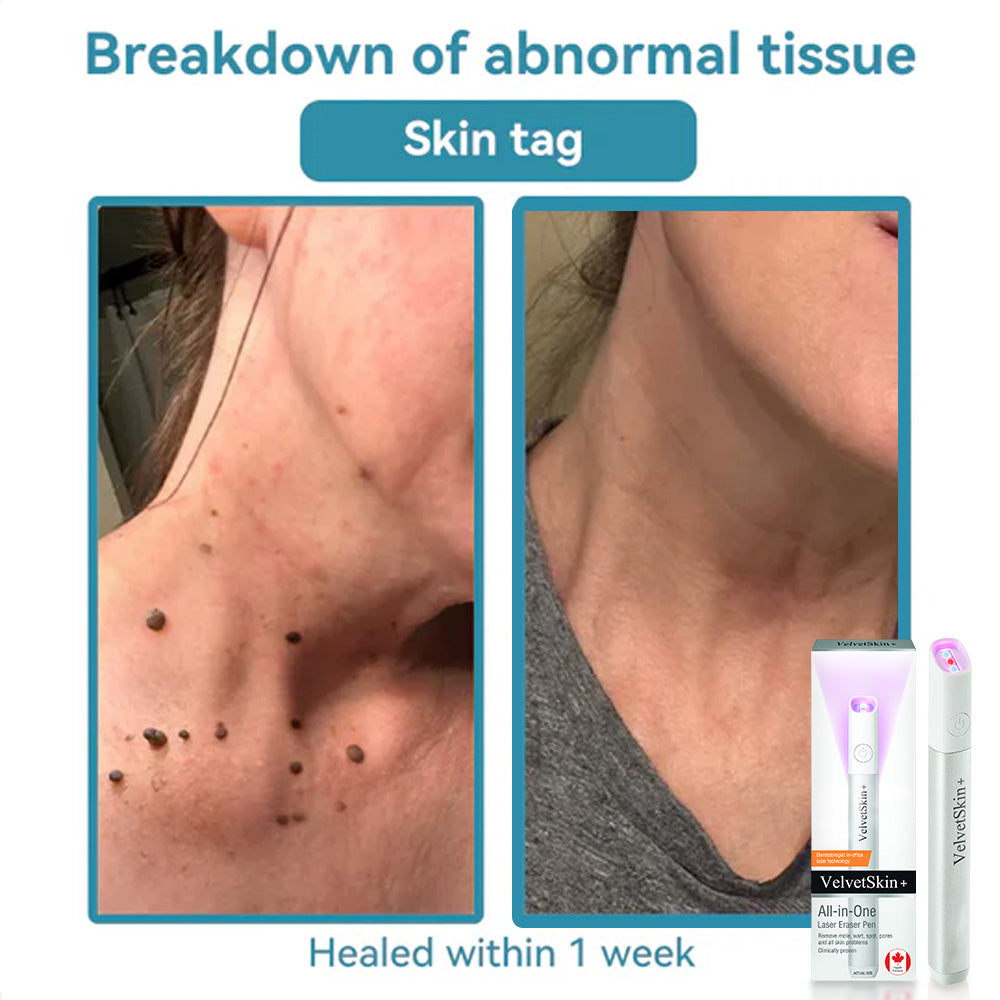 ☂WeHealthine® VelvetSkin+Series ⚔️All-in-One Laser Eraser Pen🖊️ (🔬Powered by CO₂ laser technology – effectively removes moles, warts, skin tags, pigmentation spots, and other skin imperfections)