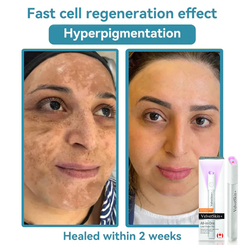 ☂WeHealthine® VelvetSkin+Series ⚔️All-in-One Laser Eraser Pen🖊️ (🔬Powered by CO₂ laser technology – effectively removes moles, warts, skin tags, pigmentation spots, and other skin imperfections)