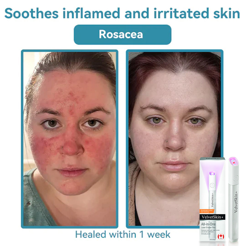 ☂WeHealthine® VelvetSkin+Series ⚔️All-in-One Laser Eraser Pen🖊️ (🔬Powered by CO₂ laser technology – effectively removes moles, warts, skin tags, pigmentation spots, and other skin imperfections)