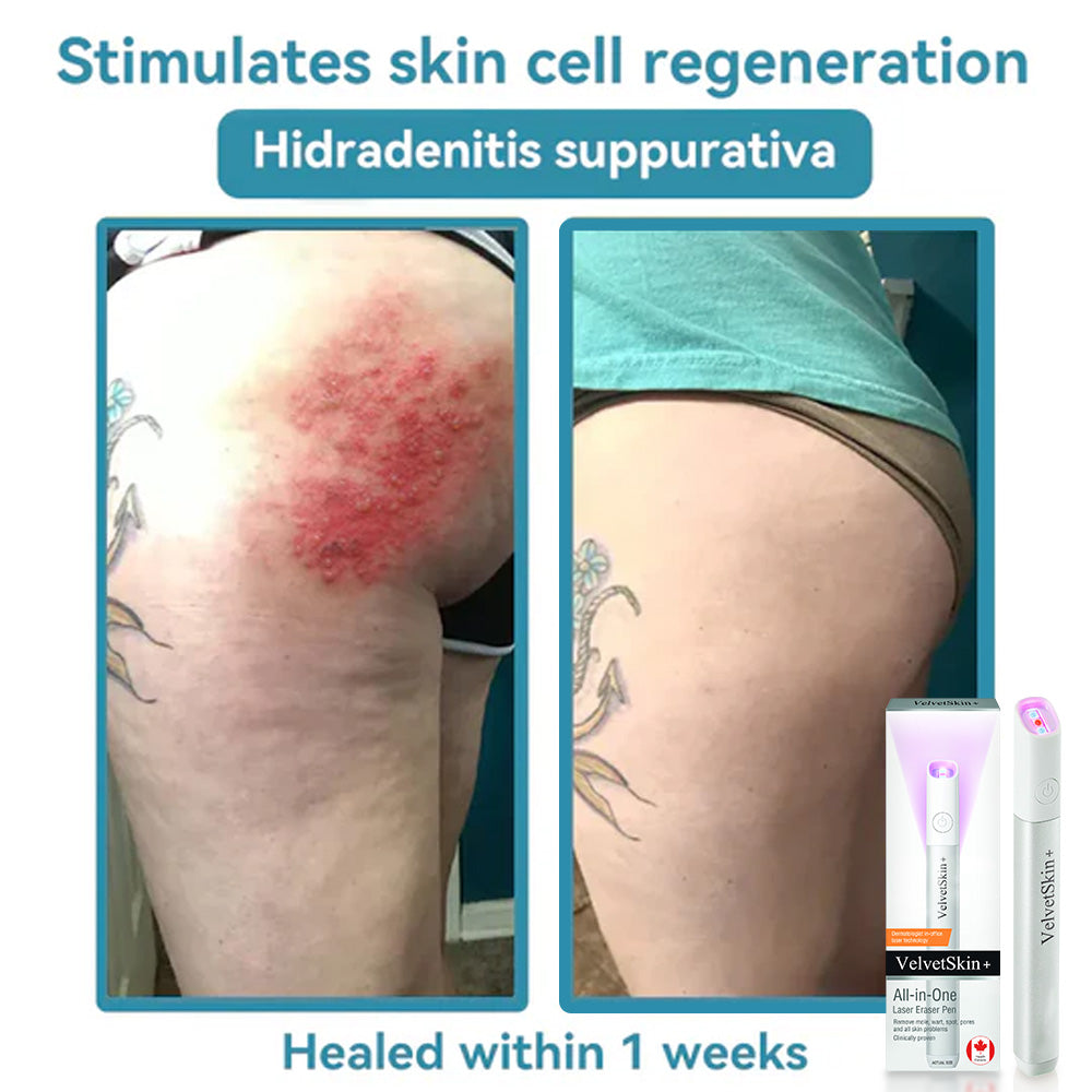 ☂WeHealthine® VelvetSkin+Series ⚔️All-in-One Laser Eraser Pen🖊️ (🔬Powered by CO₂ laser technology – effectively removes moles, warts, skin tags, pigmentation spots, and other skin imperfections)